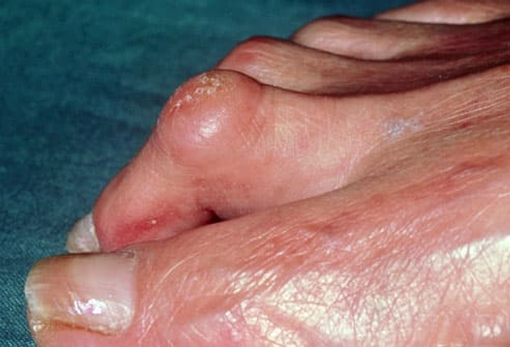 Hammertoe