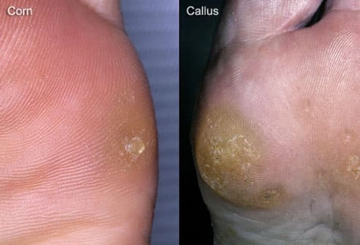 Corns and Calluses Corns and Calluses