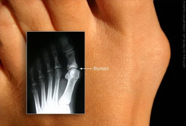 Bunion