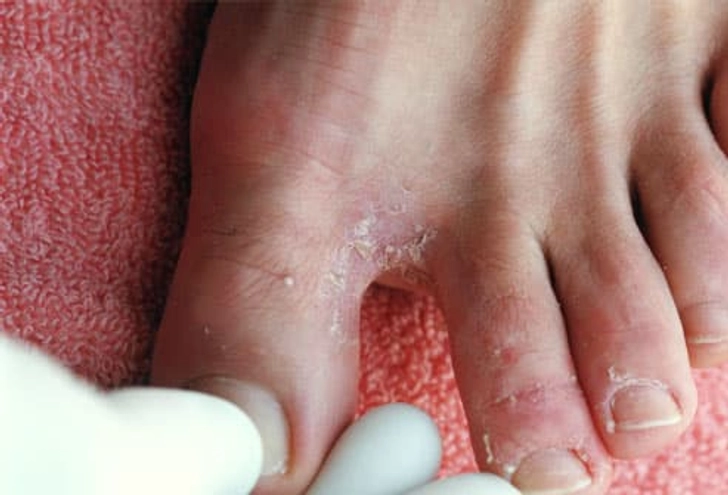 Athlete's Foot Athlete's Foot