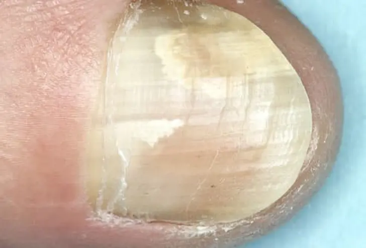Fungal Nail Infection