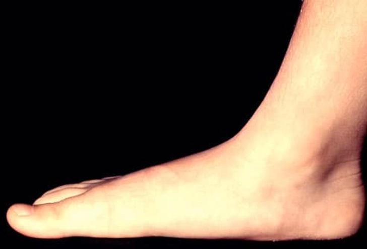 Flatfoot (Pes Planus)