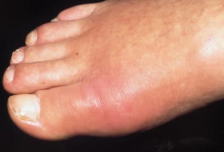 Gout
