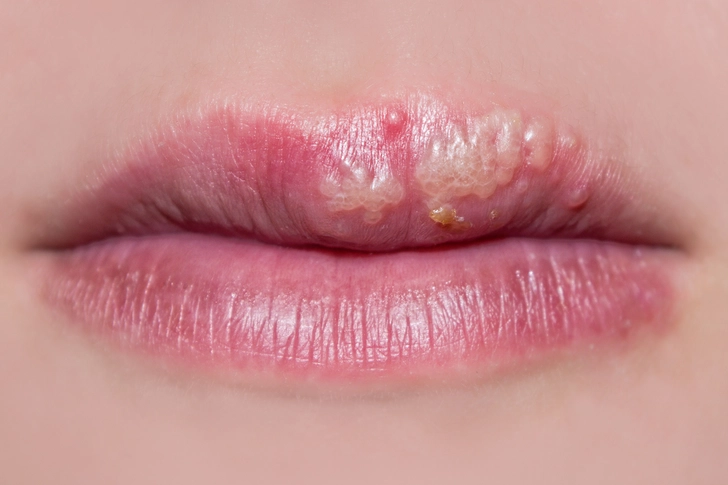 Herpes Simplex 1