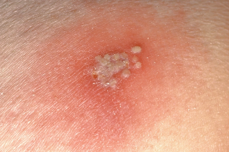 Herpes Simplex 2 Herpes Simplex 2
