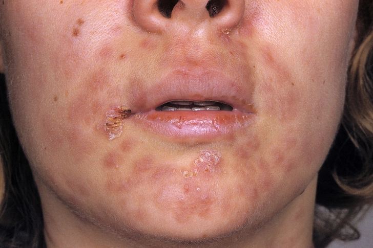 Syphilis Syphilis