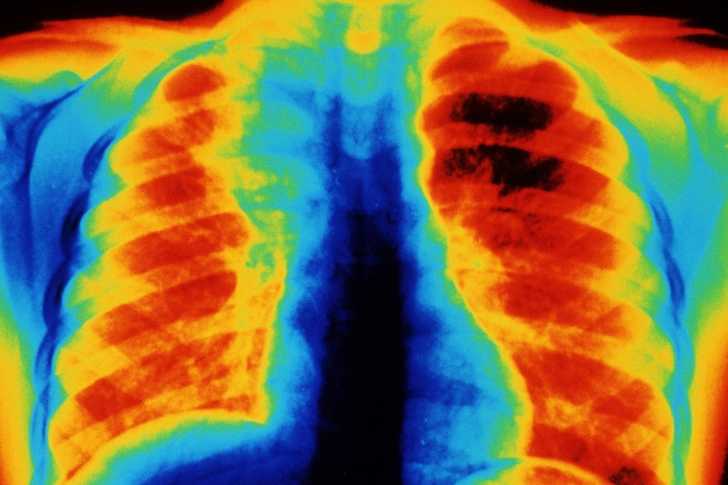 Pneumonia Pneumonia