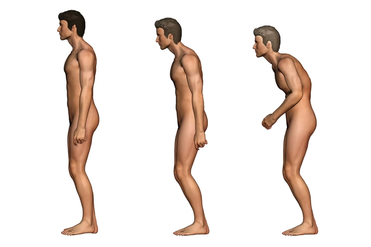 Ankylosing Spondylitis Ankylosing Spondylitis