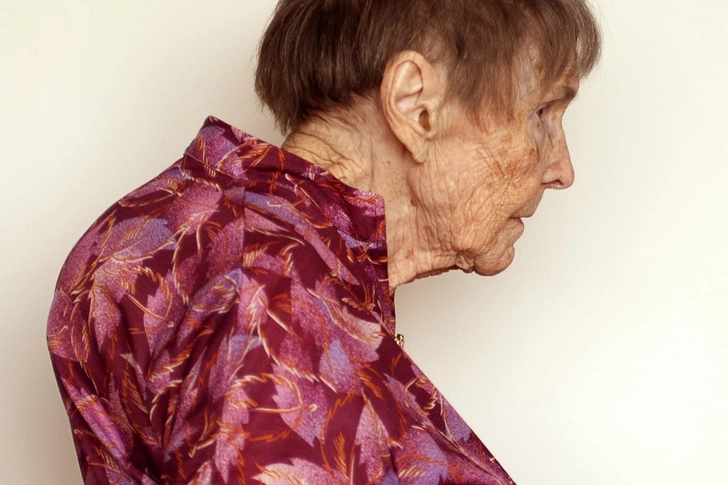 Kyphosis Kyphosis