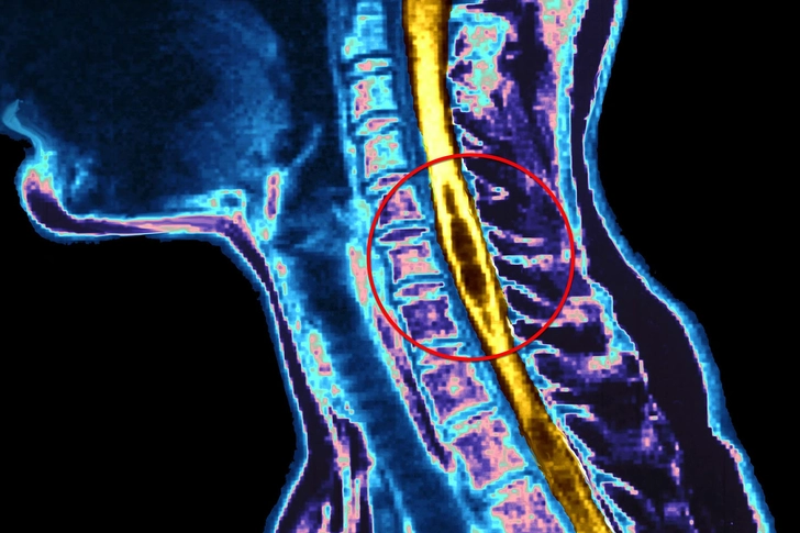 Syringomyelia Syringomyelia