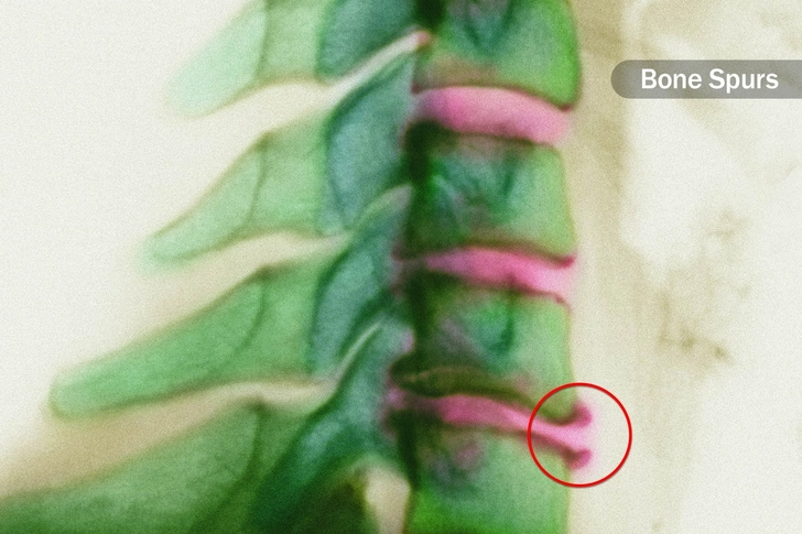Cervical Spondylosis Cervical Spondylosis