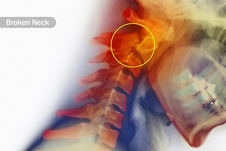Broken Neck or Back Broken Neck or Back