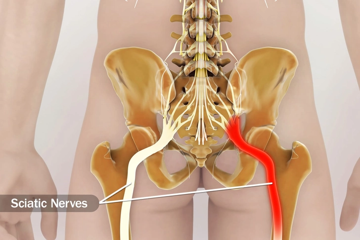 Sciatica Sciatica