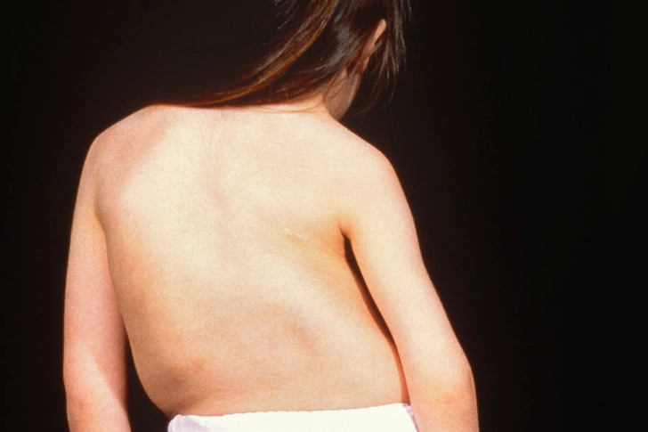 Scoliosis Scoliosis