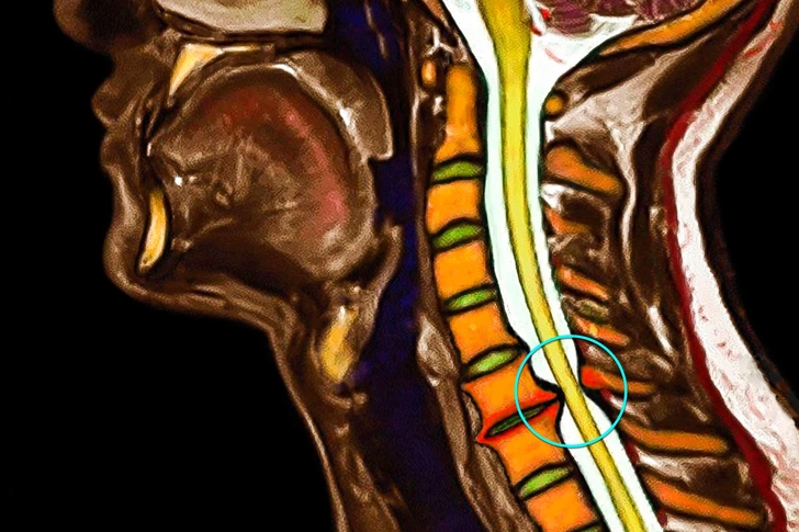 Spinal Stenosis Spinal Stenosis