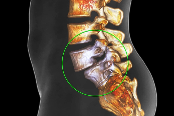 Spondylolisthesis Spondylolisthesis