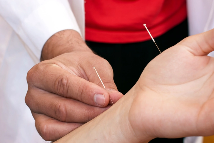Acupuncture Acupuncture