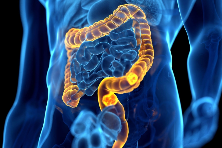 Ulcerative Colitis and Colon Cancer