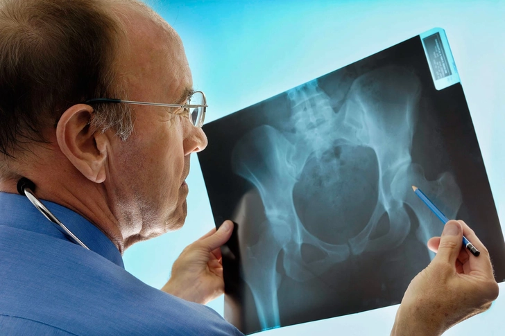 Osteoporosis