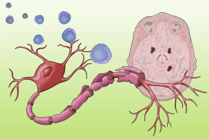 Multiple Sclerosis