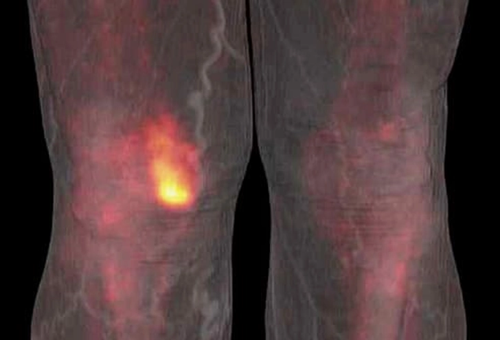 Osteonecrosis (Avascular Necrosis) Osteonecrosis (Avascular Necrosis)