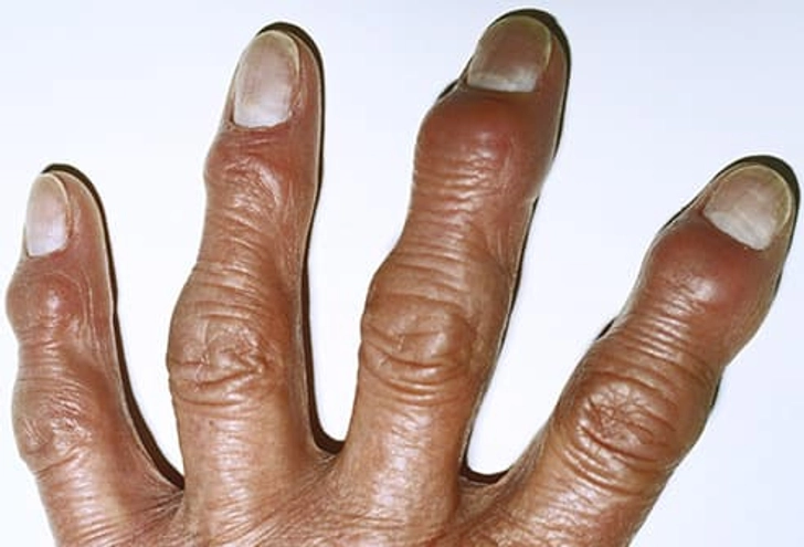 Osteoarthritis