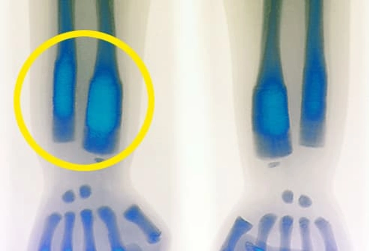 Osteopetrosis Osteopetrosis