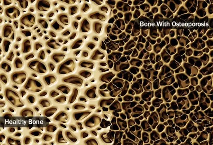Osteoporosis