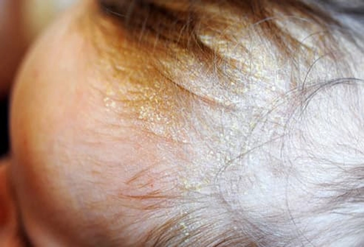 Cradle Cap Cradle Cap