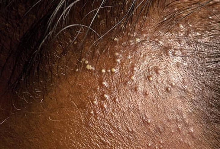 Folliculitis