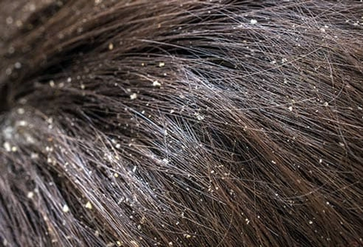 Dandruff