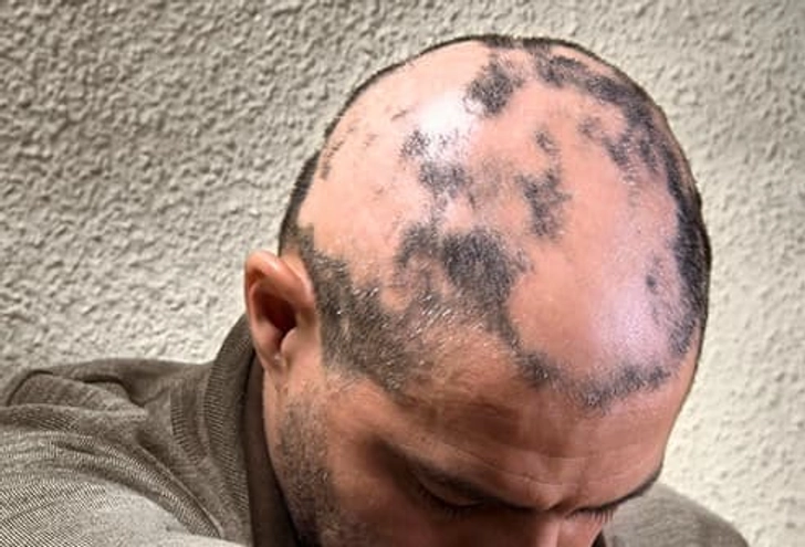 Alopecia Areata