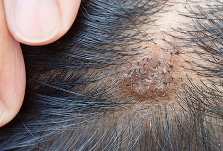 Seborrheic Dermatitis