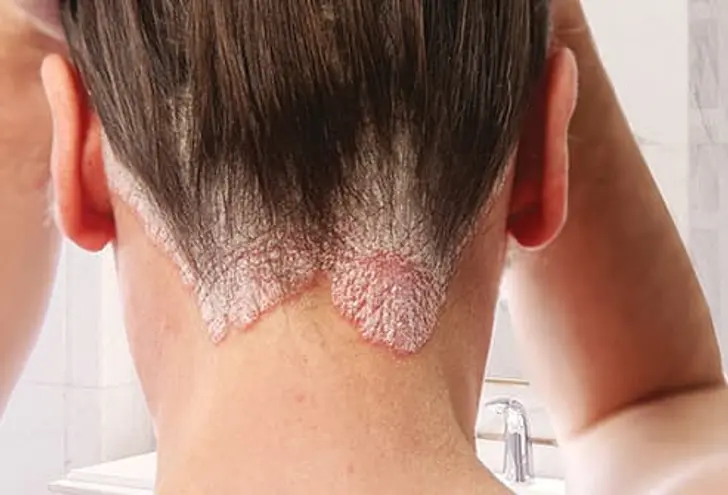 Scalp Psoriasis