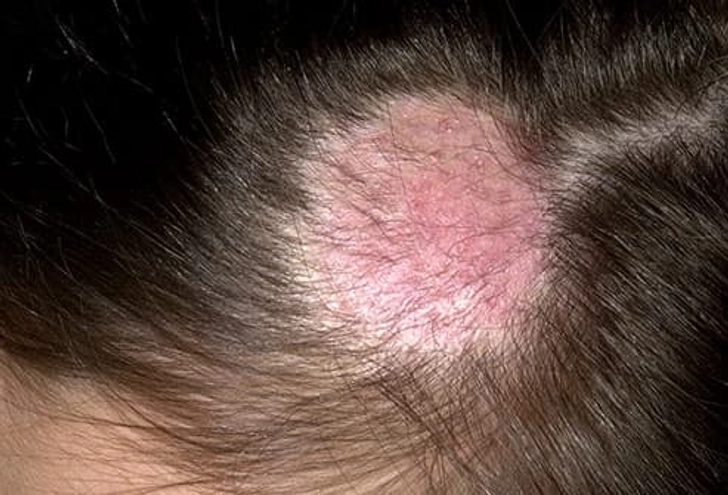 Ringworm