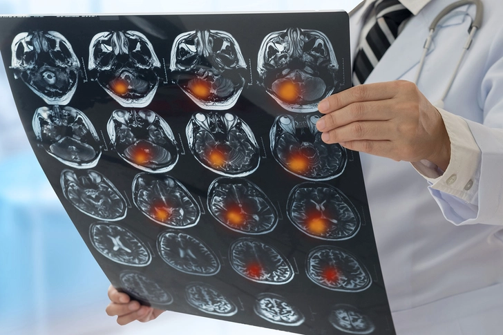 Brain Tumor