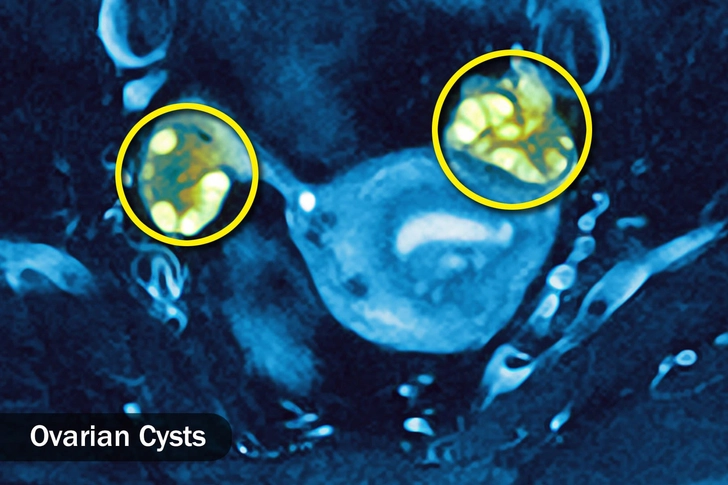 Polycystic Ovary Syndrome