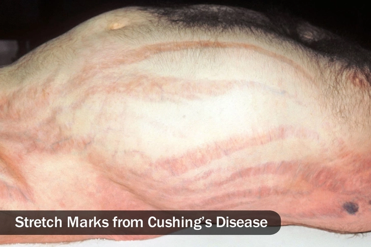Cushing’s Disease Cushing’s Disease