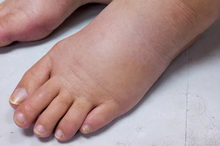 Edema and Fluid Retention Edema and Fluid Retention