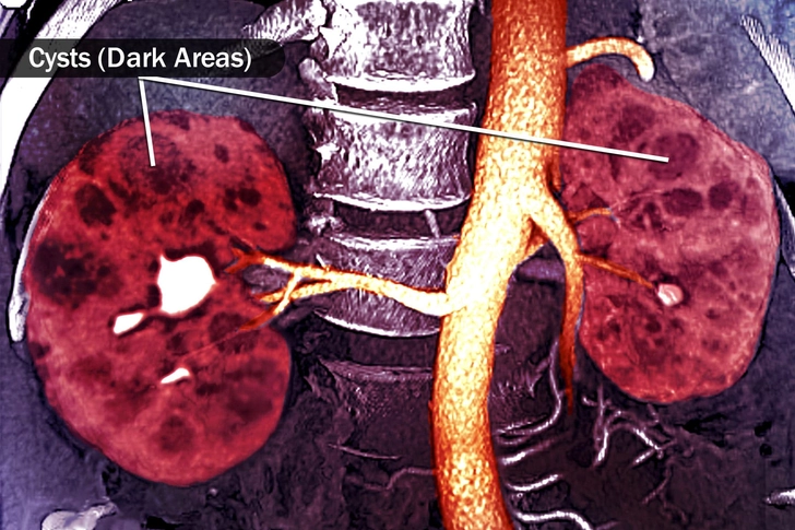 Polycystic Kidney Disease (PKD) Polycystic Kidney Disease (PKD)