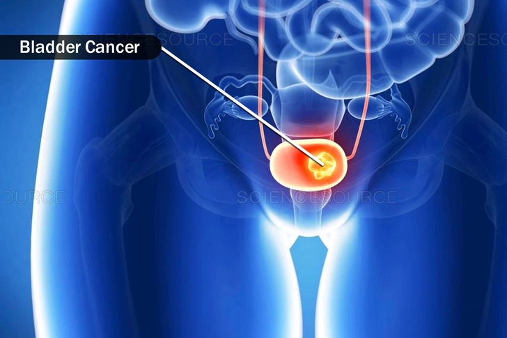 Cancer