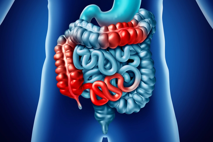 Crohn’s Disease
