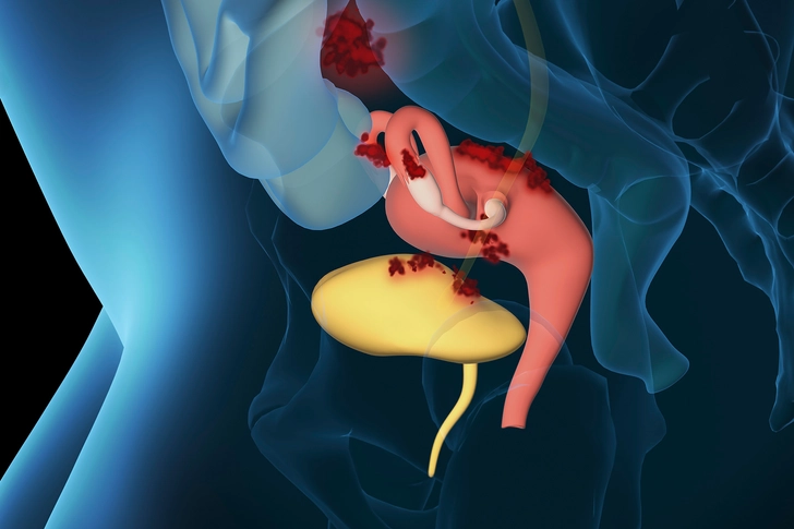 Endometriosis