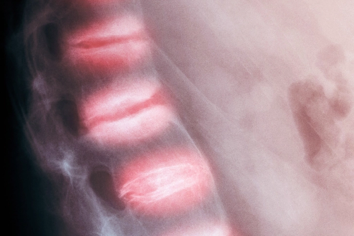 Ankylosing Spondylitis (AS)