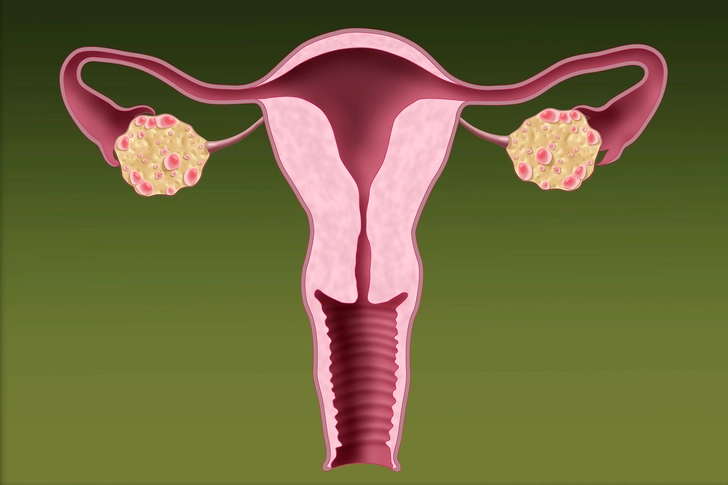 Polycystic Ovarian Syndrome (PCOS) Polycystic Ovarian Syndrome (PCOS)