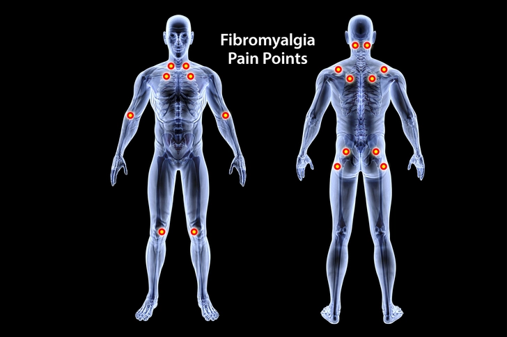 Fibromyalgia