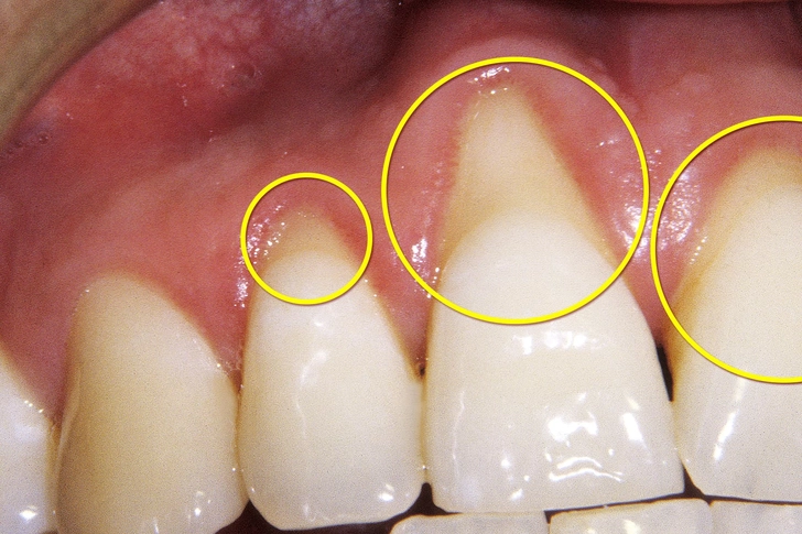 Your Gums Are Starting to Give