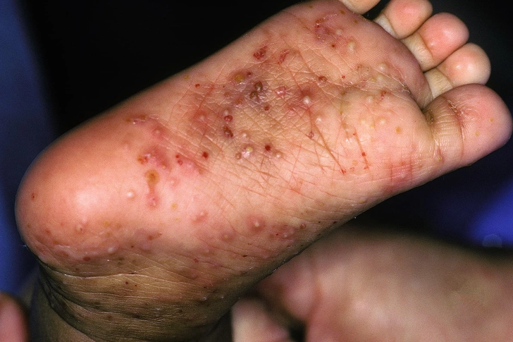 Scabies