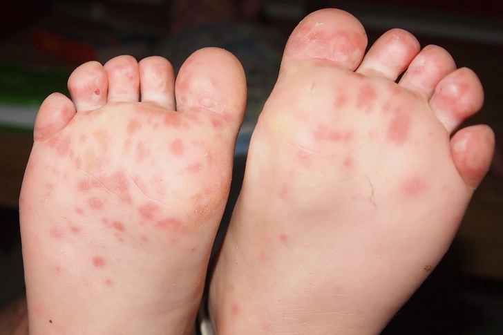 Hand-Foot-and-Mouth Disease