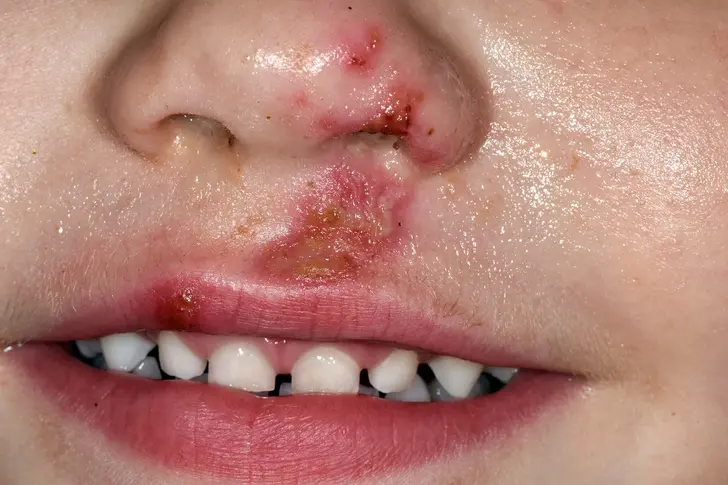 Impetigo Impetigo